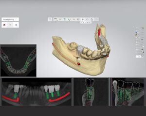 CAD-CAM Tervezés - Flex-Dent