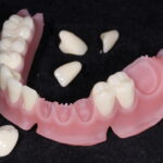 Fogsorok (3D nyomtatott) | 3D printed Dentures